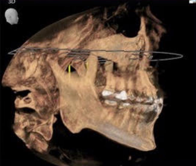 Cone-beam Computed Tomography (CBCT) 3D image of head and jaw.